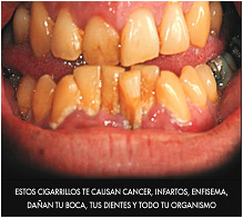 Chile 2007 Health Effects Mouth - mouth cancer, gross, smoking causes various illnesses